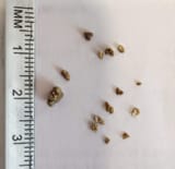 Kidney_stones