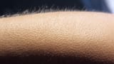 goosebumps