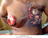 breast cancer