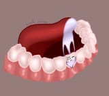 cavity