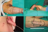 A-Guide-To-FTM-What-Is-PenilePlasty-7