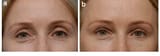 a-A-middle-age-woman-with-hollowing-of-the-upper-orbit-and-minor-tear-trough-deformity-b