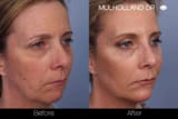 fractional-co2-before-and-after-gallery-patient-photo-37