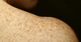 freckles