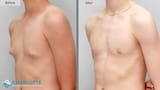 Puffy-Nipple-Gyno