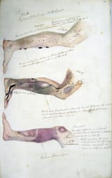A_case_of_Scurvy_journal_of_Henry_Walsh_Mahon