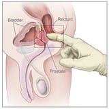 Digital_rectal_exam_nci-vol-7136-300