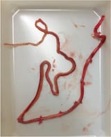 Long-fibrin-clot-completely-occluding-the-catheter-lumen-of-an-Indwelling-pleural