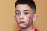 pitbull_attack_aftermath