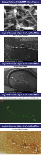 AmyloidMicroclot