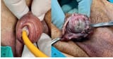 Phimosis-and-ischaemia-of-the-glans-penis-both-clinical-signs-of-penile-ischaemia-are