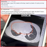 NataschaTata Reddit COVID-19 Vaccine Vaxx Jab Injuries Tumor Turbo Cancer