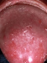 Candidal-Balanitis-pictures-1