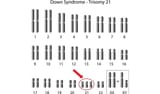 123-chromos-trisomy-21-karyotype-12-18