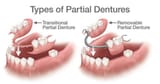 types-of-partial-dentures