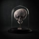 skull hydrocephalus
