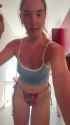 sunburn_thumb.jpg