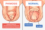 phimosis-image