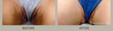 intimate-bleaching