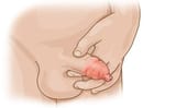 en_balanitis_kind_replacement_image