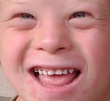 trisomy