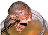 abortion12