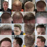 hair-transplant-recovery-timeline