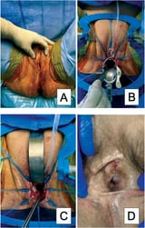 A-Patient-after-gender-affirming-penile-inversion-vaginoplasty-with-well-healed-external