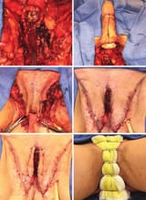 Penile-inversion-vaginoplasty-continued-Above-left-Neoclitoris-inset-Above.ppm