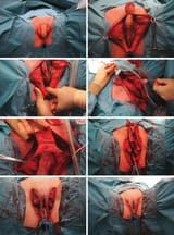 Penile-inversion-vaginoplasty-performed-in-a-51-year-old-transgender-woman-Above-left
