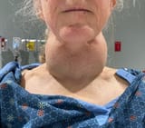 iqNeckSyndrome
