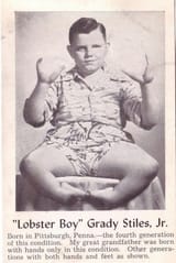 Lobster boy
