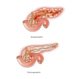 Acute-and-Chronic-Pancreatitis