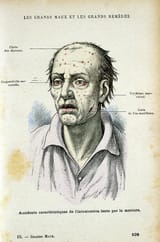 symptoms-of-long-term-mercury-poisoning-universal-history-archiveuig
