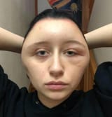 allergic reaction to skin cream 