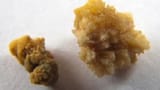 calcium oxalate kidney stones