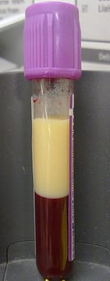 330px-Hyperlipidaemia_-_lipid_in_EDTA_tube