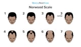 norwood-scale