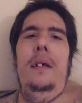 Missing teeth