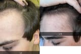 12-weeks-on-oral-min