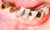 symptoms+of+tooth+decay-640w[1]