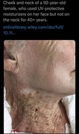 sunscreen-neck-skin-wrinkled-UV