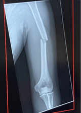 broken humerus