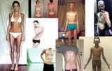 no abs anorexia