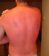 54cac758d6928_-_sunburn-3-0611-xln