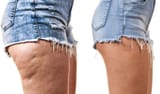 Cellulite-Treatment-Options-and-Before-and-After-Cellulite-Treatments-1080x640-1024x607-3836267206