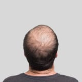 balding-royalty-free-image-1624983204