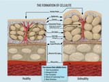 cellulite