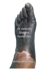 gangrene-foot-drsomesh-diabetic-foot-clinic-3_compressed