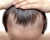 preventing-receding-hairline